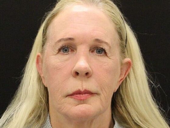 Non-Surgical Case 17 - Before