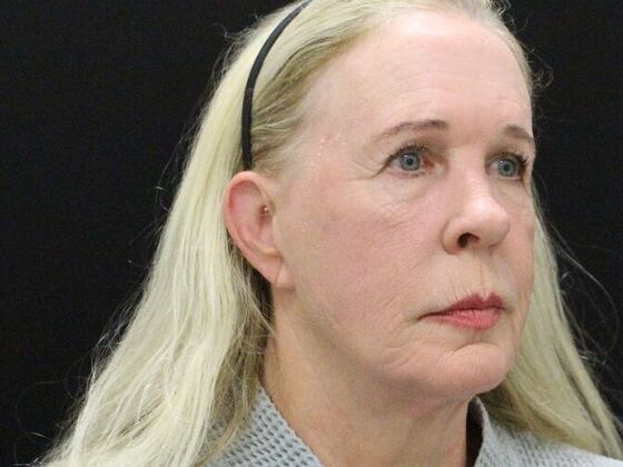 Non-Surgical: Case 17 - Before