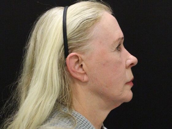 Non-Surgical: Case 17 - Before