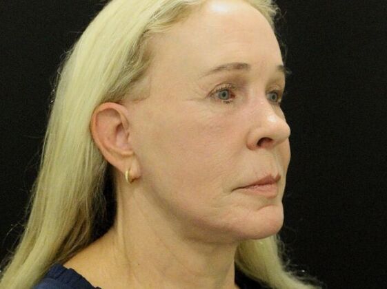 Non-Surgical: Case 17 - After