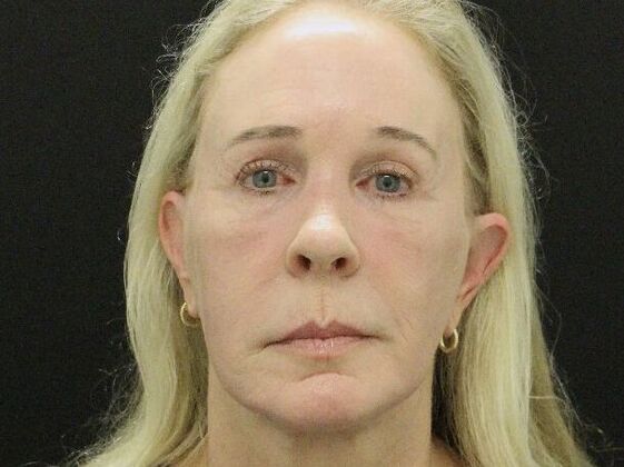 Non-Surgical Case 17 - After