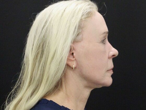 Non-Surgical: Case 17 - After