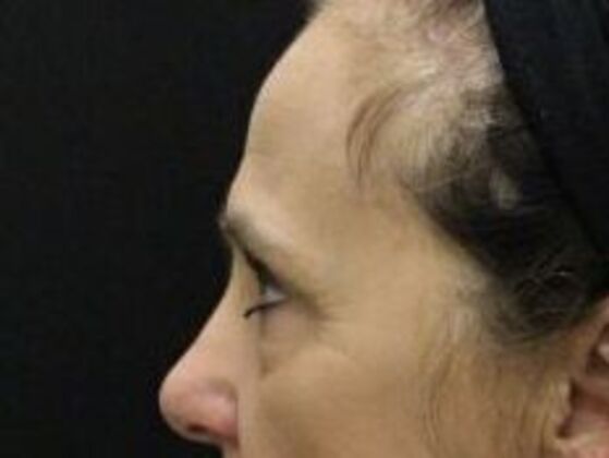 Forehead & Brow Lifts: Case 7 - Before