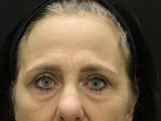 Forehead & Brow Lifts Case 7 - Before