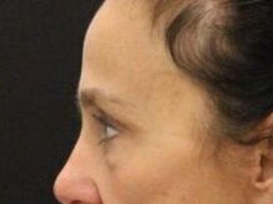 Forehead & Brow Lifts: Case 7 - After