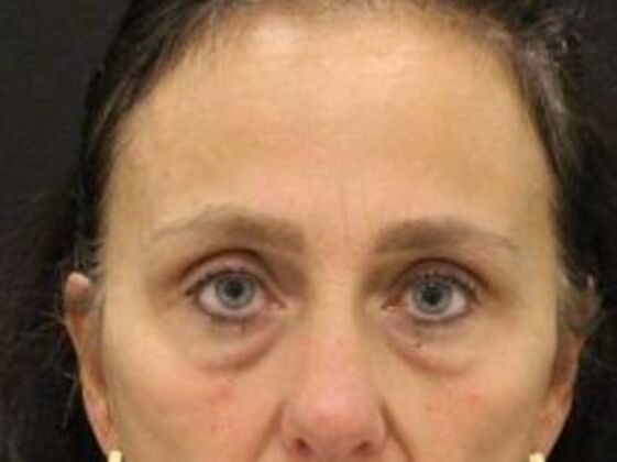 Forehead & Brow Lifts Case 7 - After