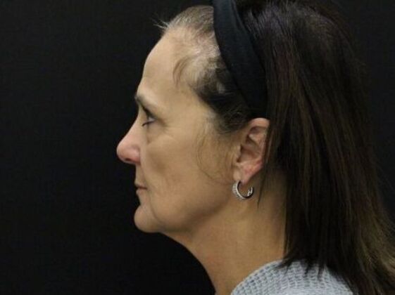 Face & Neck Lifts: Case 58 - Before