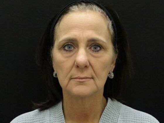 Face & Neck Lifts Case 58 - Before