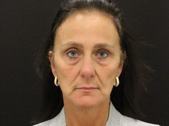 Face & Neck Lifts Case 58 - After