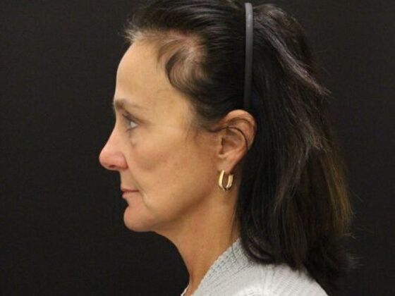 Face & Neck Lifts: Case 58 - After