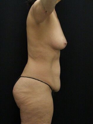 Tummy Tuck: Case 84 - Before