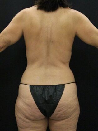 Tummy Tuck: Case 84 - Before