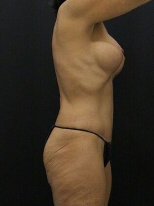 Tummy Tuck: Case 84 - After