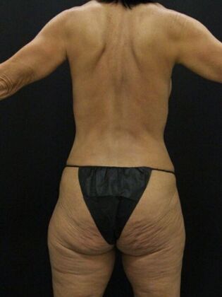 Tummy Tuck: Case 84 - After