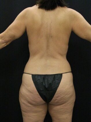 Liposuction: Case 43 - Before