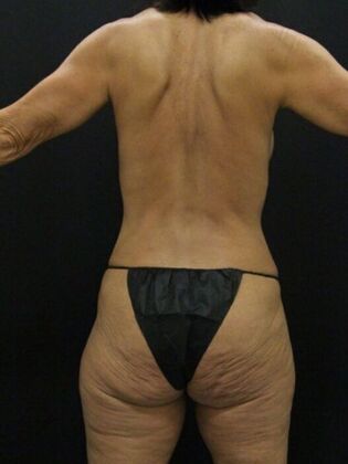 Liposuction: Case 43 - After