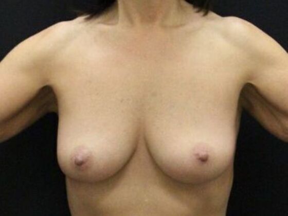 Breast Lift/Breast Lift Augmentation Case 69 - Before