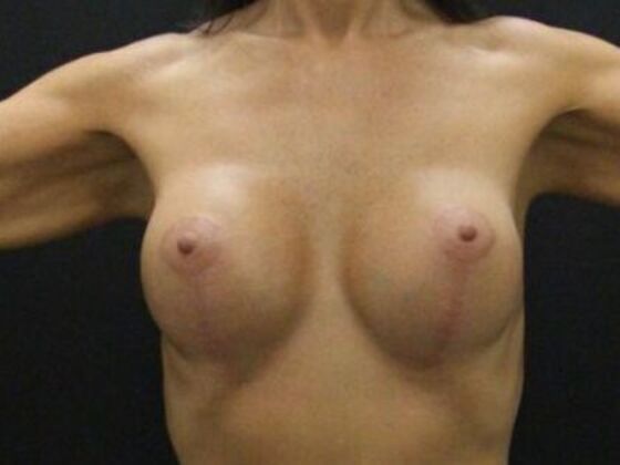 Breast Lift/Breast Lift Augmentation Case 69 - After