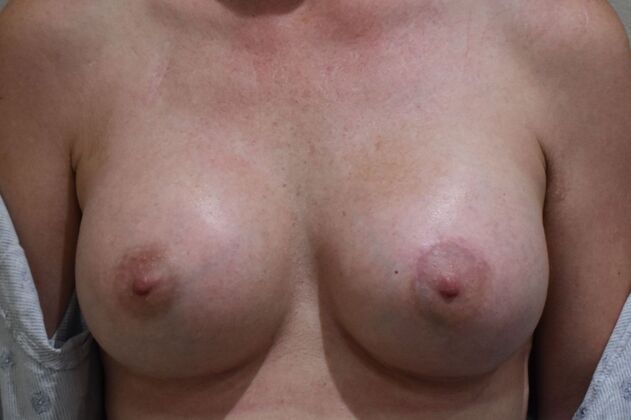 Breast Augmentation Case 800 - After