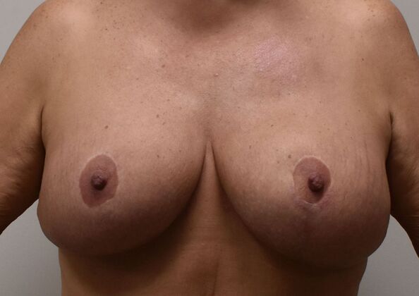 Breast Revision: Case 311 - After
