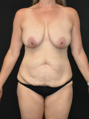 Mommy Makeover Case 19 - Before