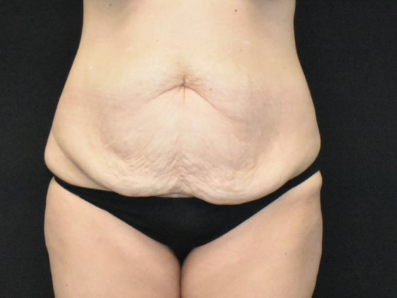 Abdominoplasty: Case 34 - Before