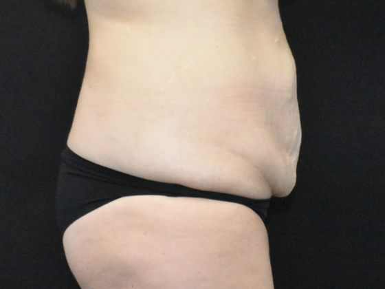 Abdominoplasty: Case 34 - Before