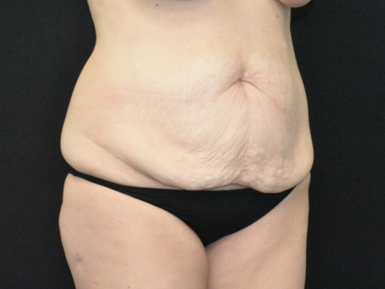Abdominoplasty: Case 34 - Before