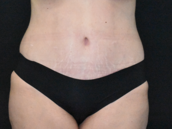 Abdominoplasty: Case 34 - After