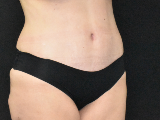 Abdominoplasty: Case 34 - After