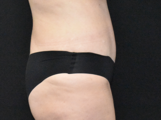 Abdominoplasty: Case 34 - After