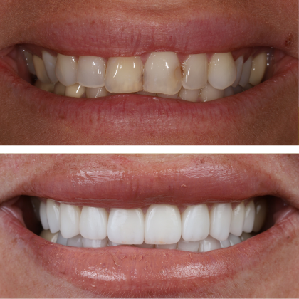 Minimal Prep Porcelain Veneers Cinzia - Before