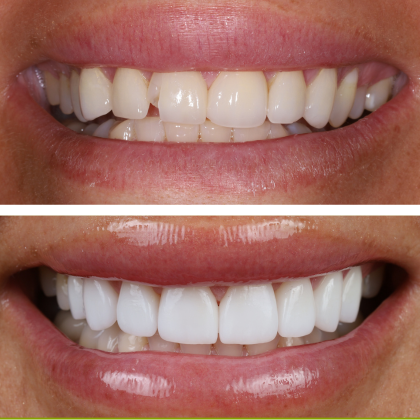 Minimal Prep Porcelain Veneers Heather - Before