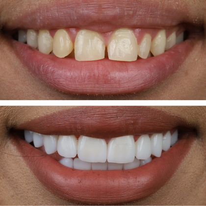 Minimal Prep Porcelain Veneers Sanah - Before