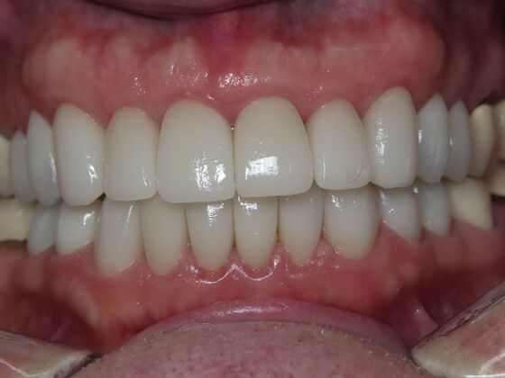 Crowns Case 3 - After