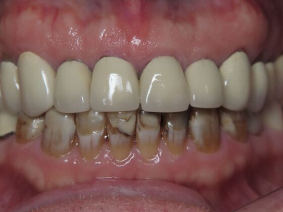 Crowns Case 3 - Before