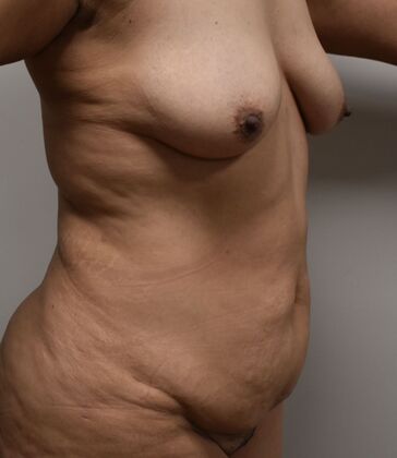 Mommy Makeover: Case 347 - Before