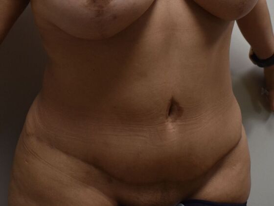 Tummy Tuck (Abdominoplasty): Case 553 - After