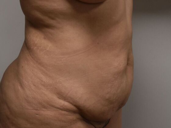 Tummy Tuck (Abdominoplasty): Case 553 - Before