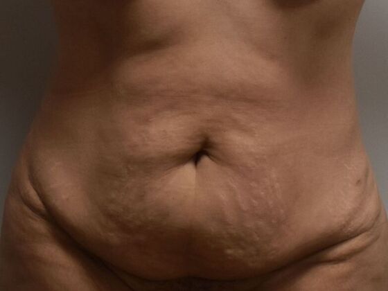 Tummy Tuck (Abdominoplasty) Case 553 - Before