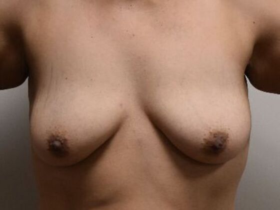 Breast Augmentation w/ Lift Case 616 - Before