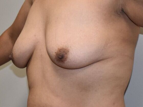 Breast Augmentation w/ Lift: Case 616 - Before