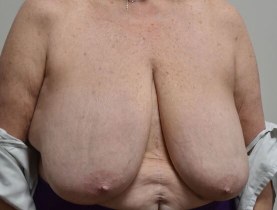 Breast Reduction: Case 201 - Before
