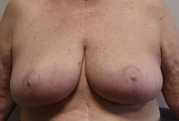 Breast Reduction Case 201 - After