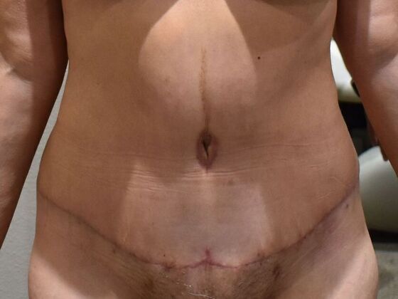 Tummy Tuck (Abdominoplasty) Case 554 - After