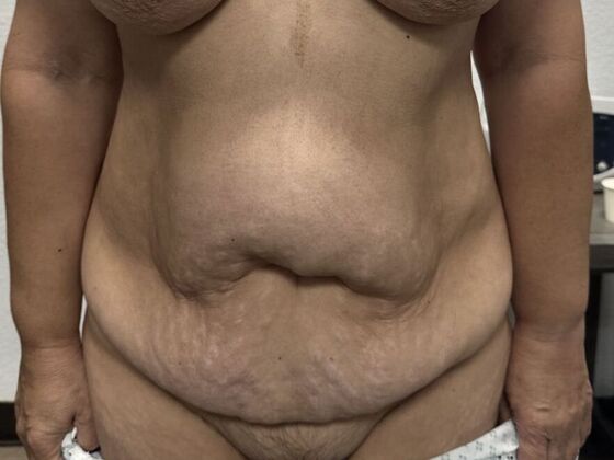 Tummy Tuck (Abdominoplasty): Case 554 - Before