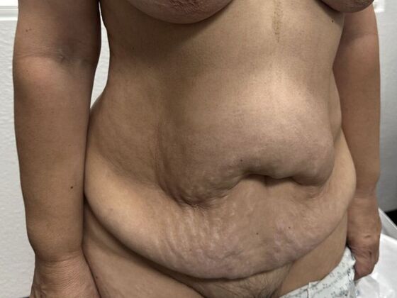 Tummy Tuck (Abdominoplasty): Case 554 - Before