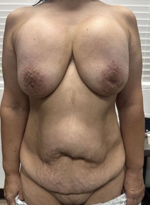 Mommy Makeover: Case 348 - Before