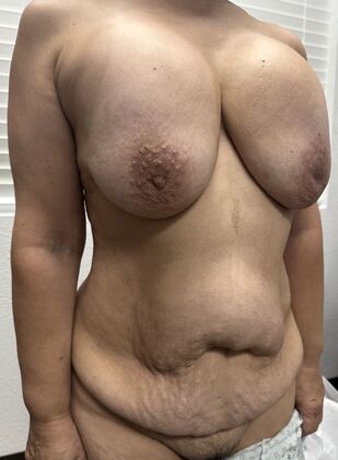 Massive Weight Loss : Case 185 - Before