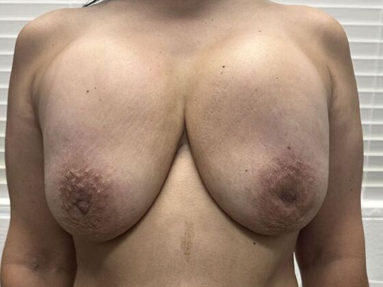 Breast Revision: Case 312 - Before